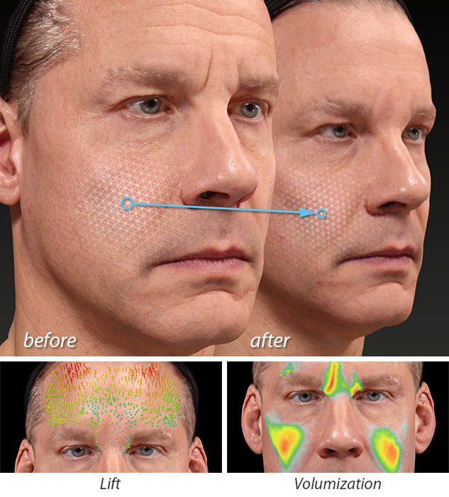 vectra 3d imaging face tightening